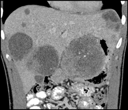 Necrotic Metastases - CTisus CT Scan