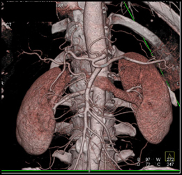 Normal Hepatic Artery - CTisus CT Scan