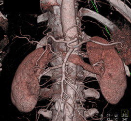 Normal Hepatic Artery - CTisus CT Scan