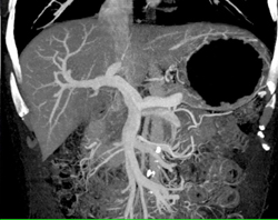 Normal Portal Vein (PV) - CTisus CT Scan