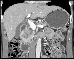 Dilated Common Bile Duct (CBD) With Pancreatic Mass - CTisus CT Scan