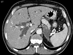 Dilated Intra-hepatic Duct - CTisus CT Scan