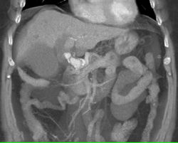 Hepatic Artery Aneurysm - CTisus CT Scan