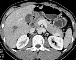 Right Hepatic Vein Infarction - CTisus CT Scan