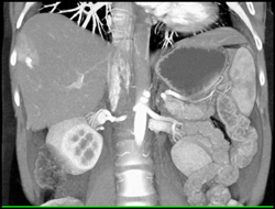 Hemangioma - CTisus CT Scan