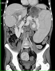 Liver Abscess - CTisus CT Scan