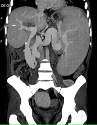 Liver Abscess - CTisus CT Scan