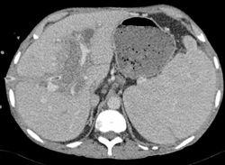 Liver Abscess - CTisus CT Scan