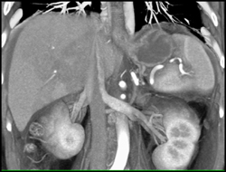 Perfusion Changes Due to Portal Vein Thrombosis. Collaterals on Venous Phase Images - CTisus CT Scan