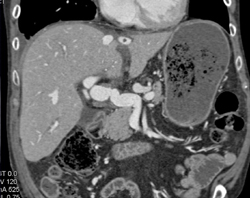 Post Hepatic Artery Stenosis of Portal Vein - CTisus CT Scan