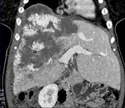 Giant Cavernous Hemangioma - CTisus CT Scan