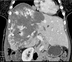 Giant Cavernous Hemangioma - CTisus CT Scan