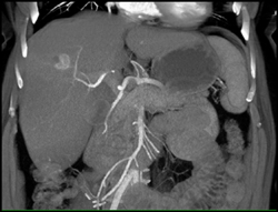 Liver Metastases - CTisus CT Scan