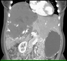 Giant Hemangioma on Bosniak Grade Ib??? - CTisus CT Scan