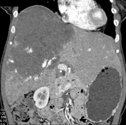 Giant Cavernous Hemangioma - CTisus CT Scan