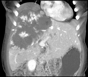 Giant Cavernous Hemangioma - CTisus CT Scan