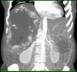 Giant Cavernous Hemangioma - CTisus CT Scan