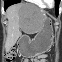 Giant Cavernous Hemangioma - CTisus CT Scan