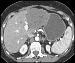 Giant Cavernous Hemangioma - CTisus CT Scan