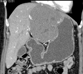 Giant Cavernous Hemangioma - CTisus CT Scan