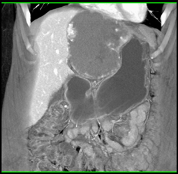 Giant Cavernous Hemangioma - CTisus CT Scan