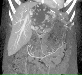 Giant Cavernous Hemangioma - CTisus CT Scan