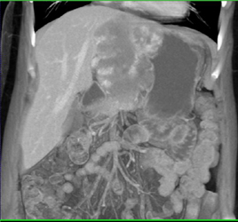 Giant Cavernous Hemangioma - CTisus CT Scan