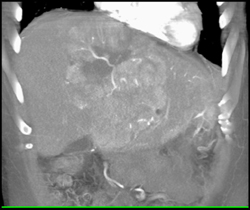 Hepatoma With Neovascularity - CTisus CT Scan