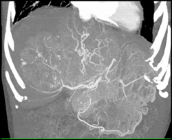 Hepatoma With Neovascularity - CTisus CT Scan