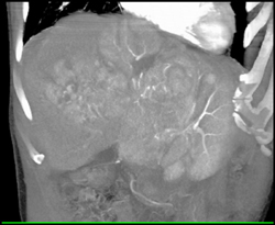 Hepatoma With Neovascularity - CTisus CT Scan