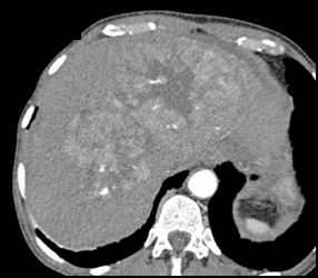 Hepatoma With Neovascularity - CTisus CT Scan