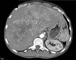 Hepatoma With Neovascularity - CTisus CT Scan