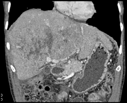 Hepatoma With Neovascularity - CTisus CT Scan