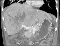 Hepatoma With Neovascularity - CTisus CT Scan