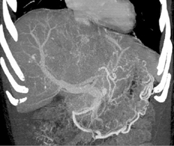 Hepatoma With Neovascularity - CTisus CT Scan