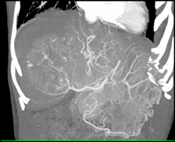 Hepatoma With Neovascularity - CTisus CT Scan