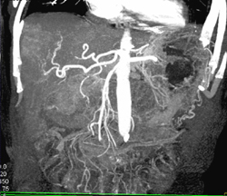 Hepatoma With Neovascularity - CTisus CT Scan