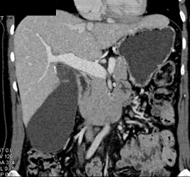 Distended Gallbladder - CTisus CT Scan