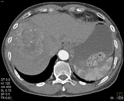 Hepatoma on Various Phases - CTisus CT Scan