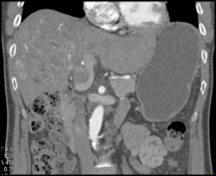 Hepatoma With Neovascularity - CTisus CT Scan