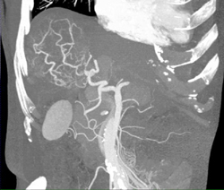 Hepatoma With Neovascularity - CTisus CT Scan