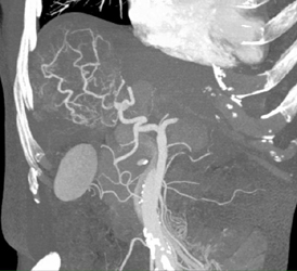 Hepatoma With Neovascularity - CTisus CT Scan