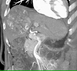 Hepatoma With Neovascularity - CTisus CT Scan