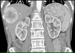 Metastatic Islet Cell Tumor With Tail of Pancreas Neuroendocrine Tumor - CTisus CT Scan