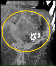 Islet Cell Tumor Invades the Portal Vein - CTisus CT Scan