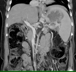 Partial Portal Vein Thrombosis Seen on VRT and Not MIP Images - CTisus CT Scan