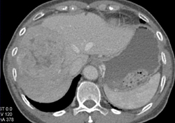 Hepatoma - CTisus CT Scan