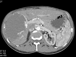 Hemangioma - CTisus CT Scan