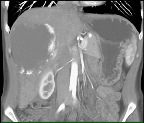 Hemangioma - CTisus CT Scan