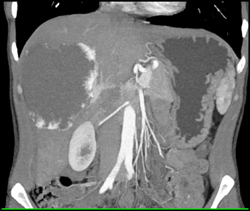 Hemangioma - CTisus CT Scan